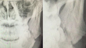 Scott Quigg's X-Ray of his broken jaw. 